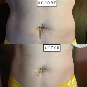 Body Contouring, Shaping & Toning Photo